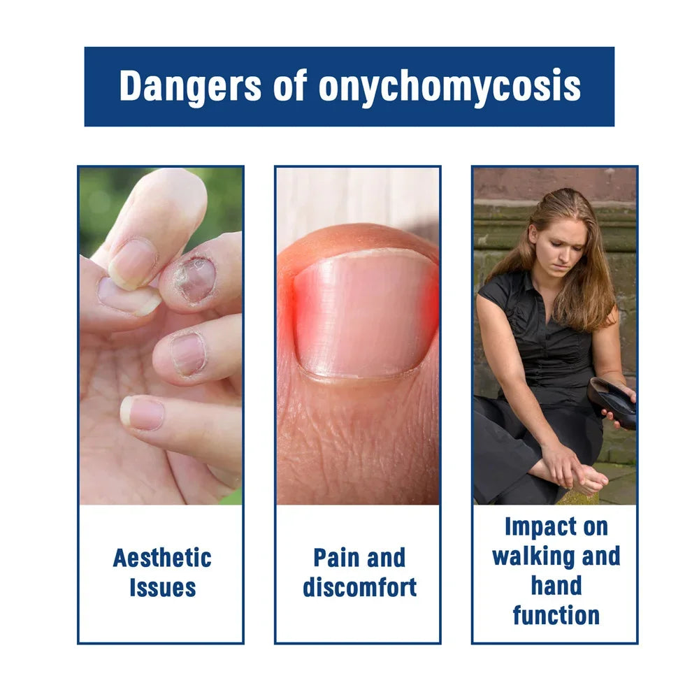 Fungal Nail Treatment Serum – Anti-Fungal & Nail Repair Essence Info Draft Submit Title