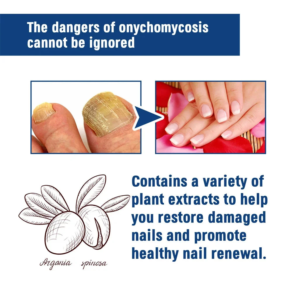 Fungal Nail Treatment Serum – Anti-Fungal & Nail Repair Essence Info Draft Submit Title