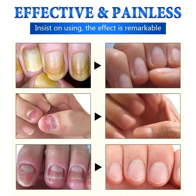 Fungal Nail Treatment Serum – Anti-Fungal & Nail Repair Essence Info Draft Submit Title