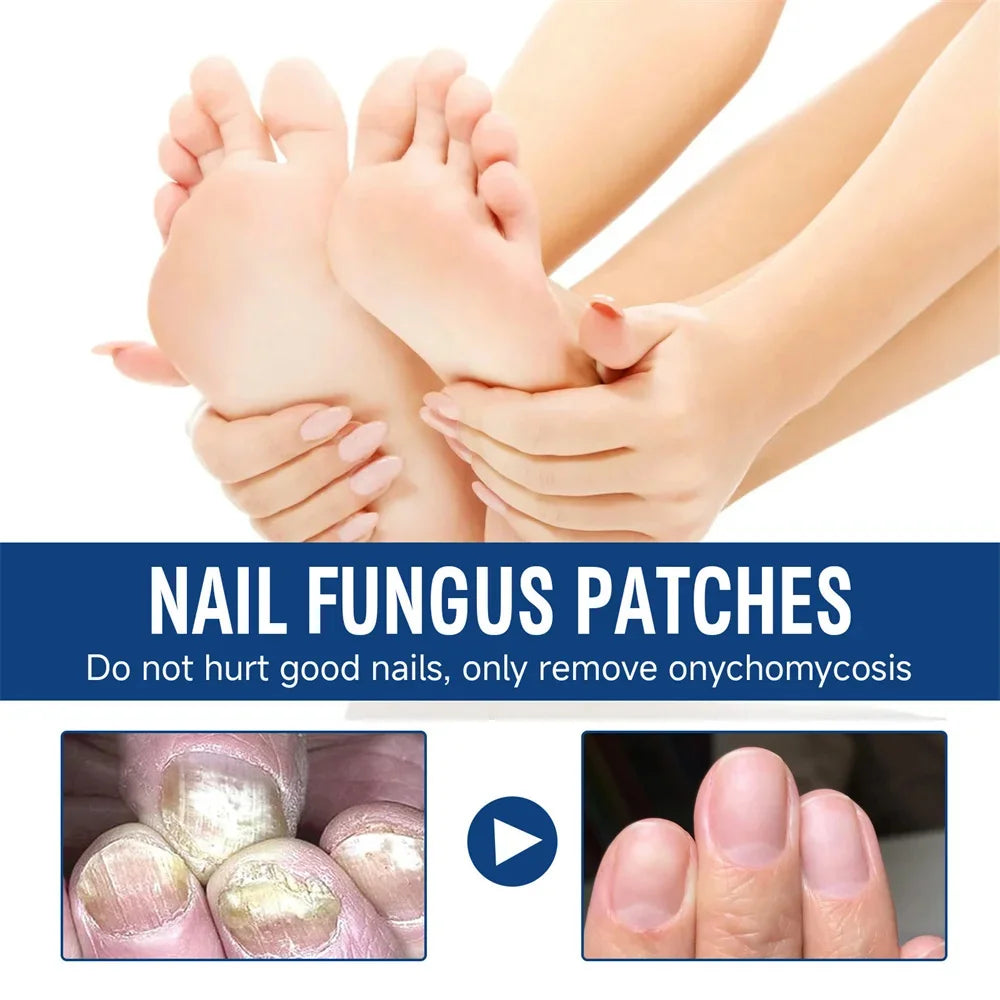 Fungal Nail Treatment Serum – Anti-Fungal & Nail Repair Essence Info Draft Submit Title