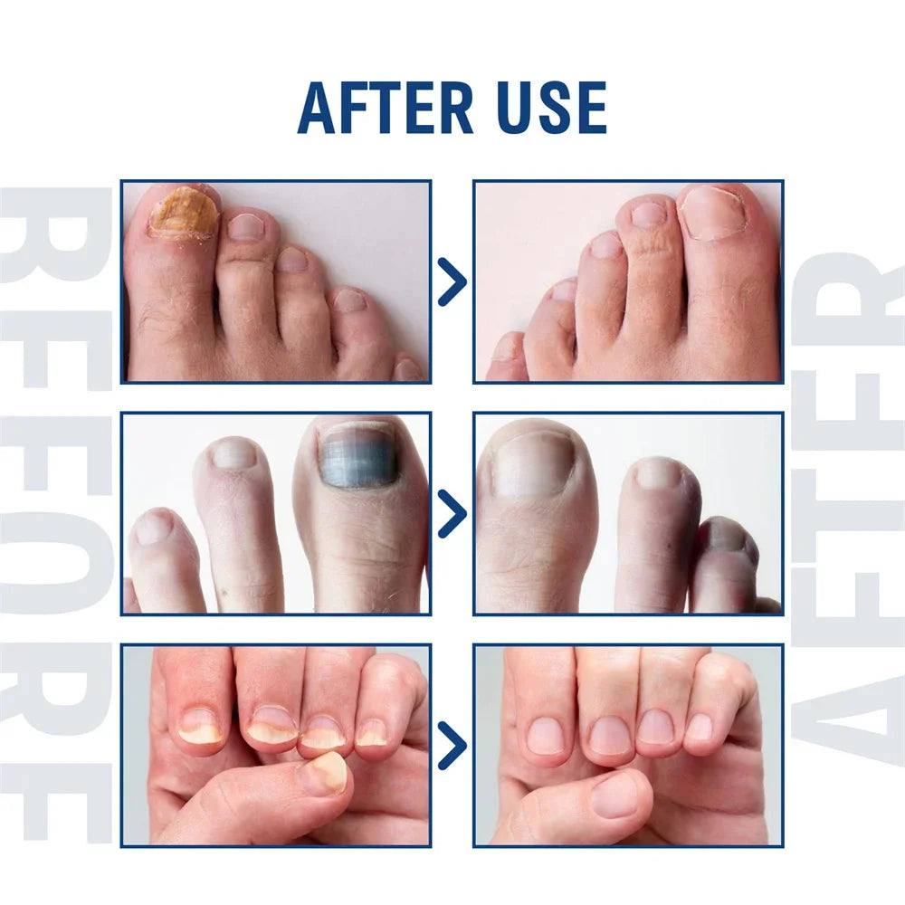 Fungal Nail Treatment Serum – Anti-Fungal & Nail Repair Essence Info Draft Submit Title