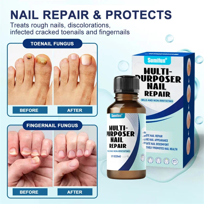 Fungal Nail Treatment Serum – Anti-Fungal & Nail Repair Essence Info Draft Submit Title