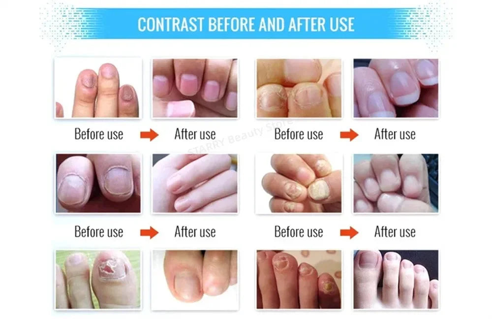 Fungal Nail Treatment Serum – Anti-Fungal & Nail Repair Essence Info Draft Submit Title