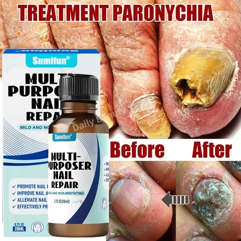 Fungal Nail Treatment Serum – Anti-Fungal & Nail Repair Essence Info Draft Submit Title