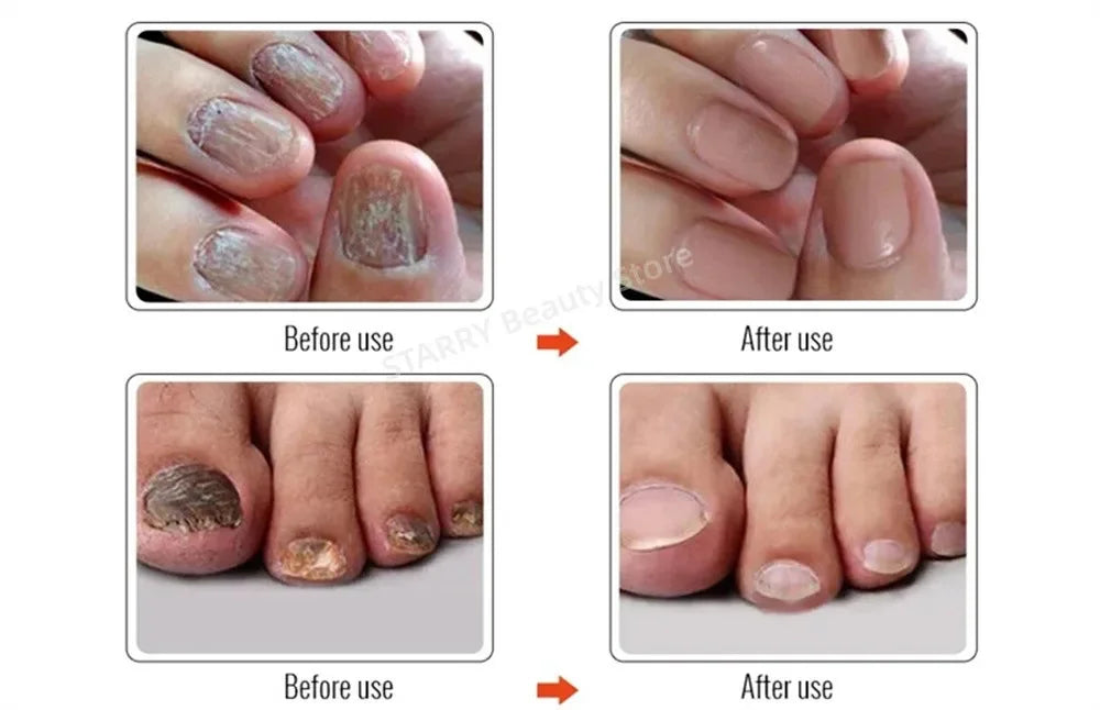 Fungal Nail Treatment Serum – Anti-Fungal & Nail Repair Essence Info Draft Submit Title