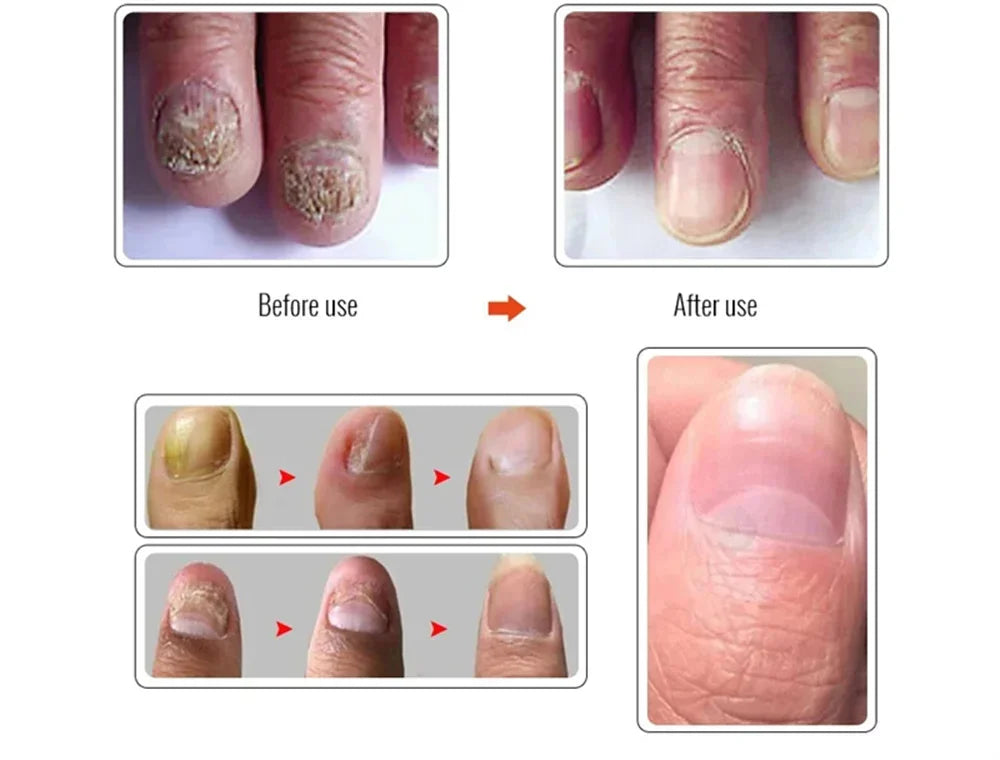 Fungal Nail Treatment Serum – Anti-Fungal & Nail Repair Essence Info Draft Submit Title