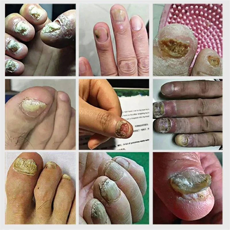 Fungal Nail Treatment Serum – Anti-Fungal & Nail Repair Essence Info Draft Submit Title