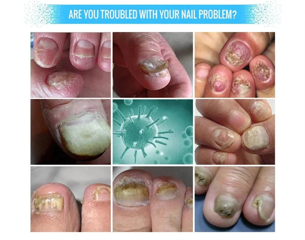 Fungal Nail Treatment Serum – Anti-Fungal & Nail Repair Essence Info Draft Submit Title