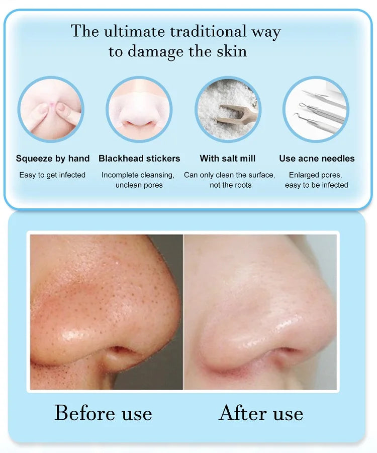 3-Mode Face Vacuum Blackhead Remover – Deep Cleansing Beauty Device